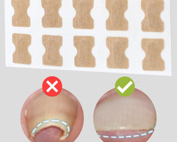 (50% Discount) FinePatches™ | Correction Patches for Beautiful and Healthy Nails